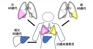 世界初の生体肺肝同時移植手術の実施について