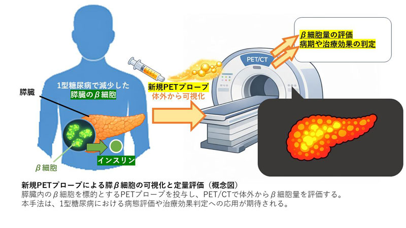1型糖尿病の“見える”膵臓評価を可能に―新規PET検査による膵β細胞量評価―