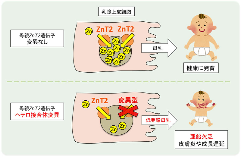 低亜鉛母乳による乳児亜鉛欠乏症 国内で予測より数多く発生していることを示唆 京都大学