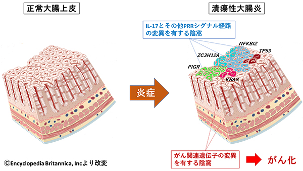 潰瘍性大腸炎による上皮再構築メカニズムと発がんとの関係を解明
