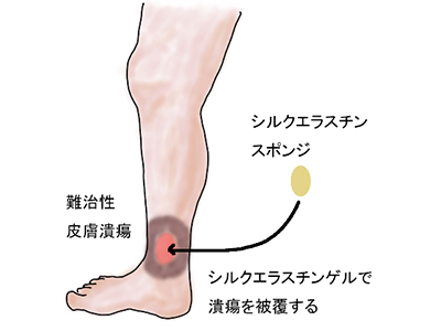 シルクエラスチン（R）スポンジを用いる企業治験