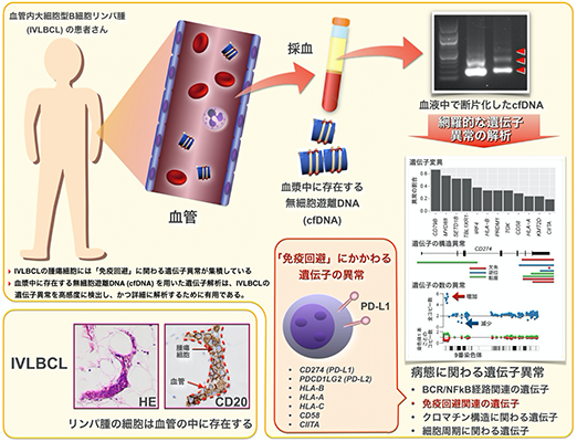 診断困難な悪性リンパ腫病型における遺伝子異常を末梢血を用いて高感度に検出