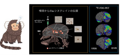 パーキンソン病の認知機能障害は鼻からはじまる?～レヴィ小体病における嗅覚系伝播経路の解明～