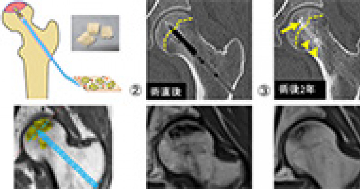 特発性大腿骨頭壊死症に対する再生医療の良好な結果 京都大学