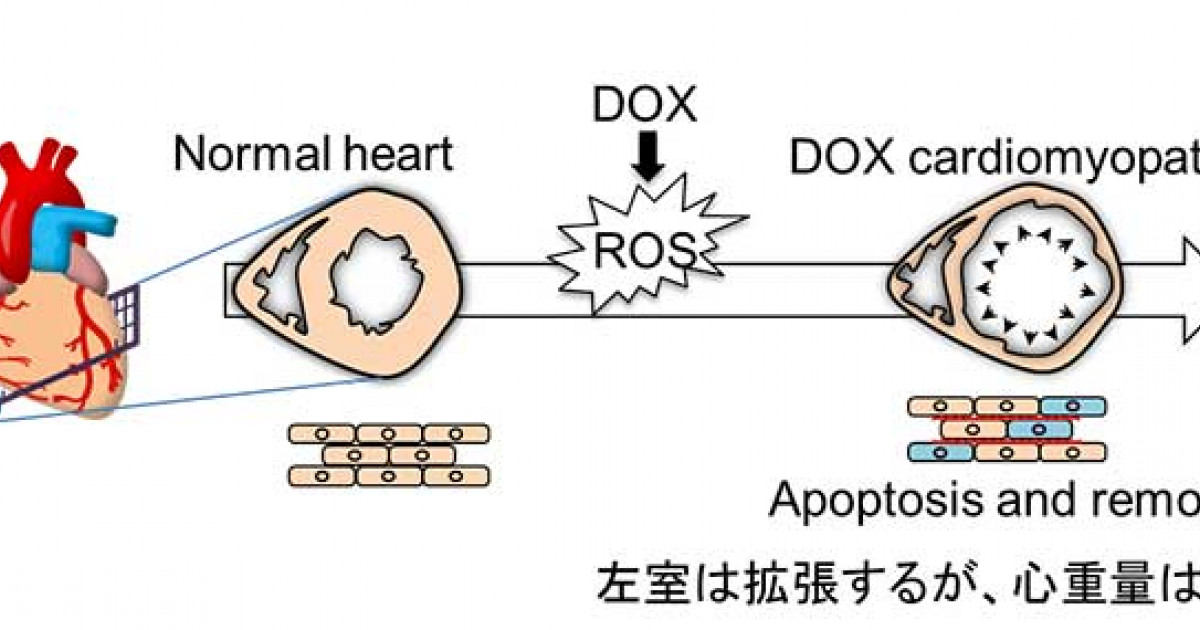 抗がん剤で心筋が萎縮する機序を解明 抗がん剤の副作用軽減に期待 京都大学