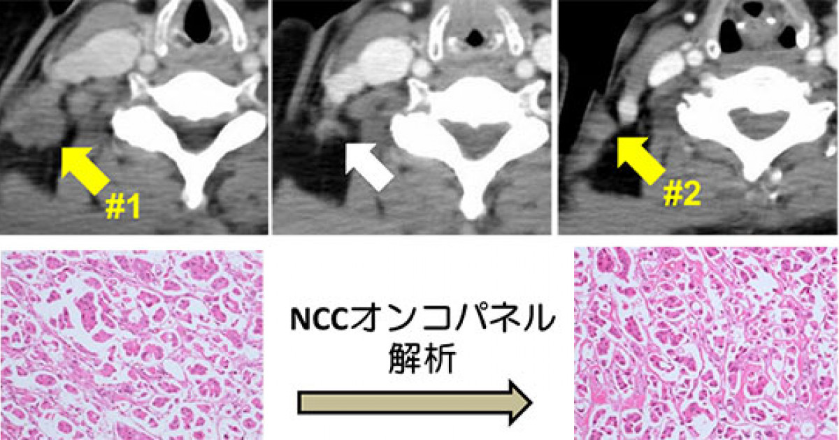 RET融合遺伝子上に生じるアロステリック効果を持つ二次変異 －分子標的治療薬に対するがんの新しい薬剤耐性メカニズムを発見－
