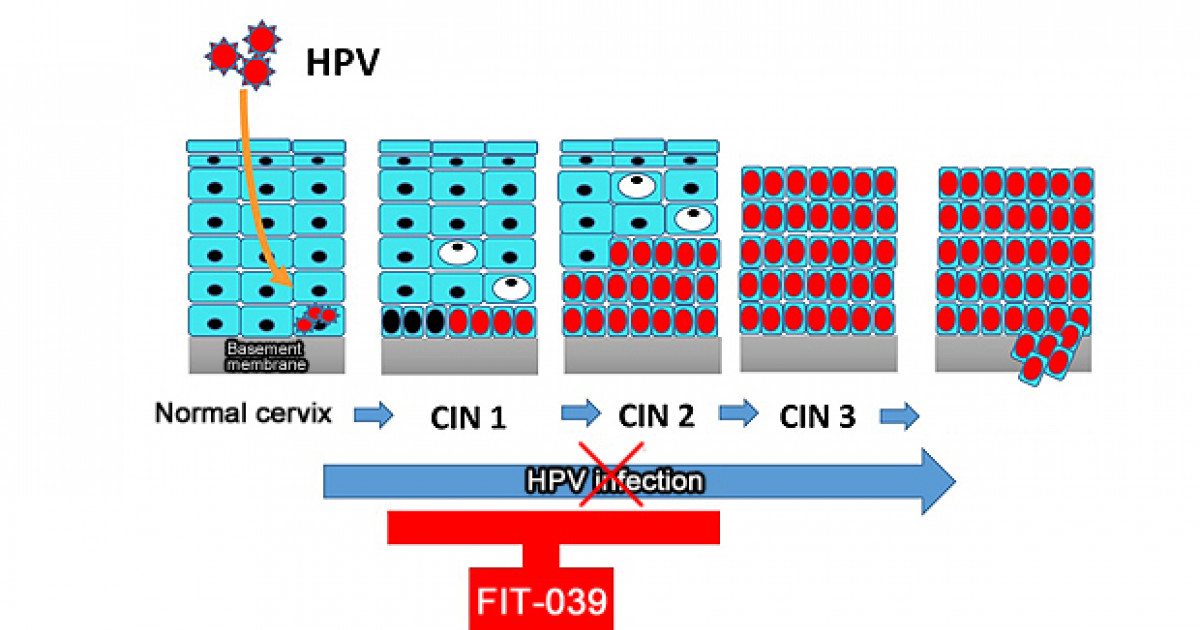 Novel treatment for cervical cancer precursor goes into clinical trial ...