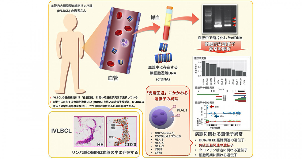 診断困難な悪性リンパ腫病型における遺伝子異常を末梢血を用いて高感度に検出 京都大学