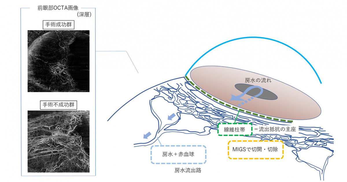 前眼部OCTAを用いた線維柱帯切開術効果予測 -房水主流出路の 前眼部OCTAを用いた線維柱帯切開術効果予測 -房水主流出路の
