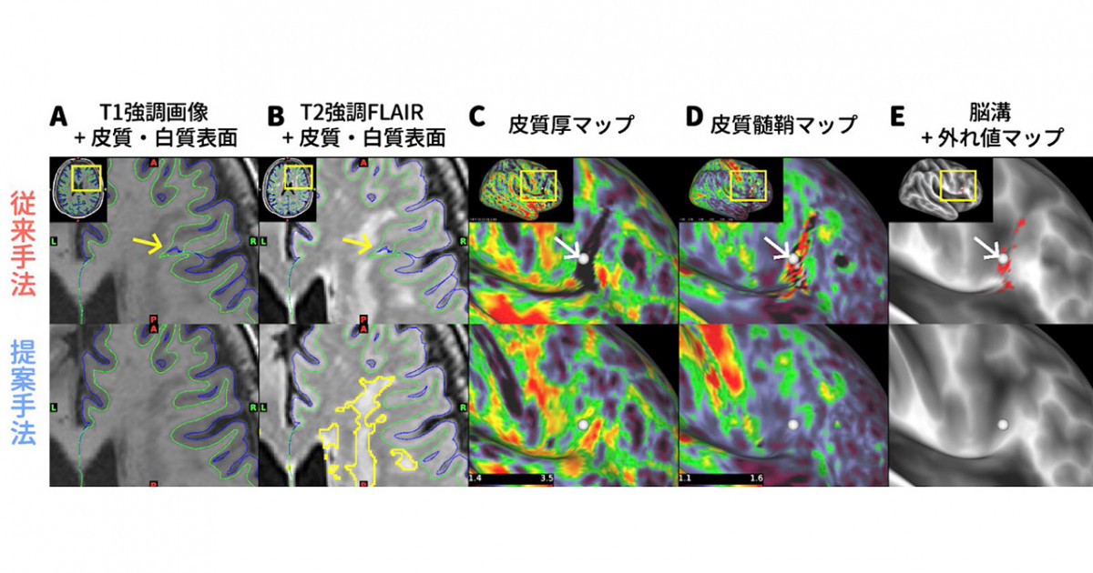 ありふれた脳の白質病変がMRI画像解析を悪化させていた―従来手法に機械