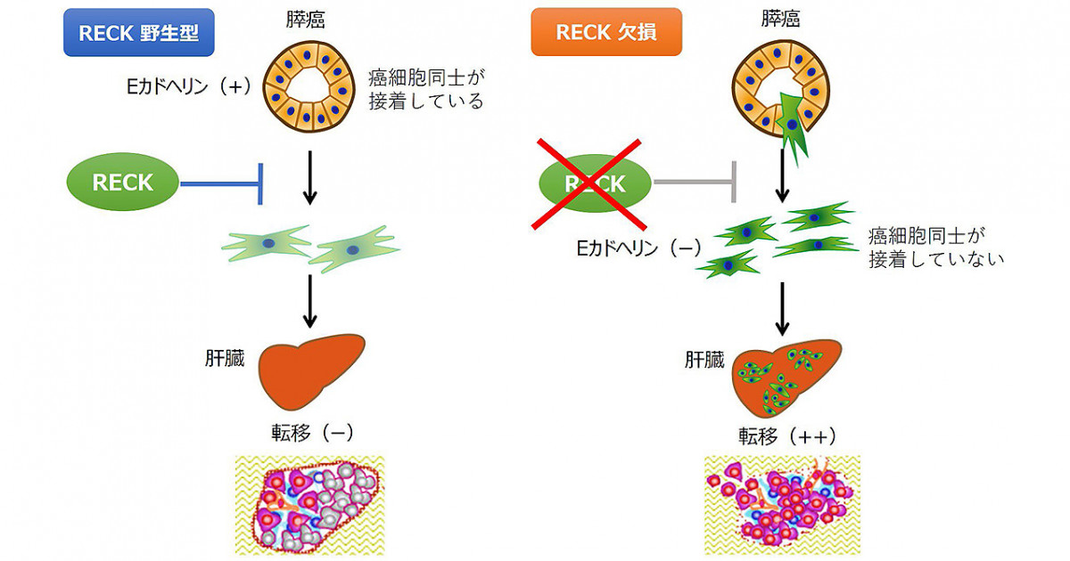 膵癌悪性化の分子機構解明—RECK発現の低下が膵癌の浸潤・転移を