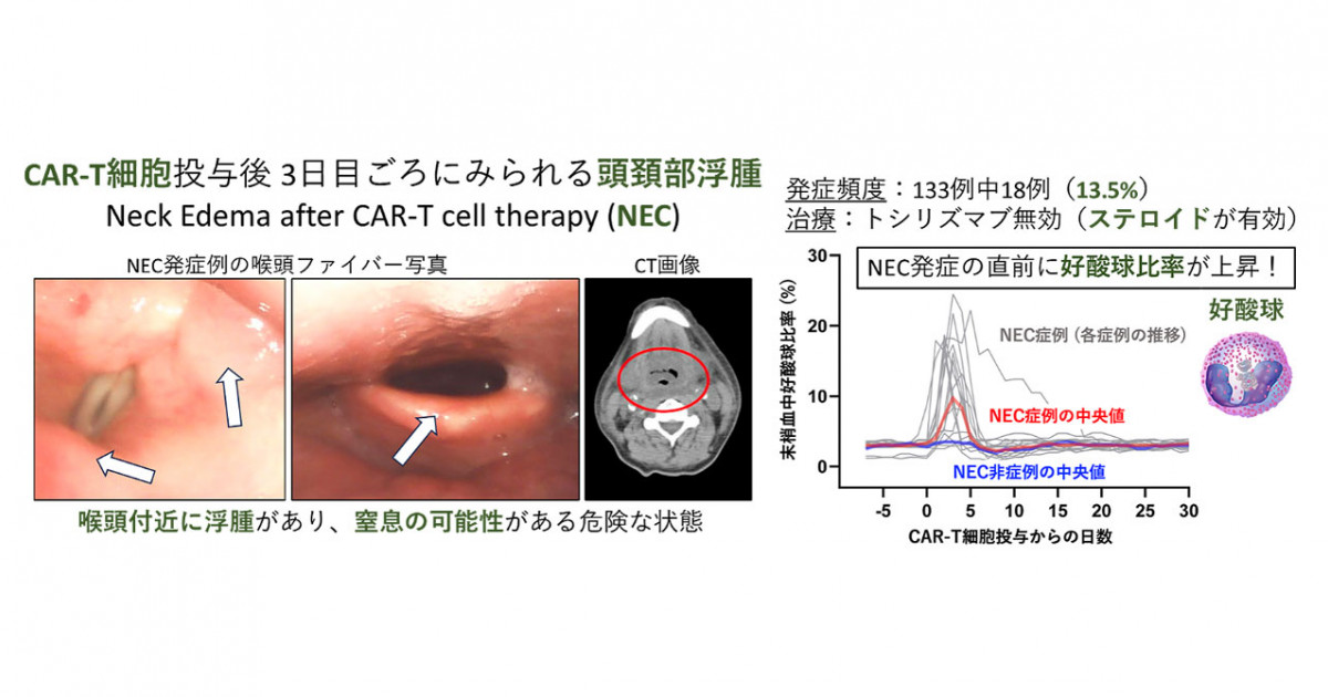 キメラ抗原受容体T細胞投与後の合併症を新たに報告―頭頚部浮腫