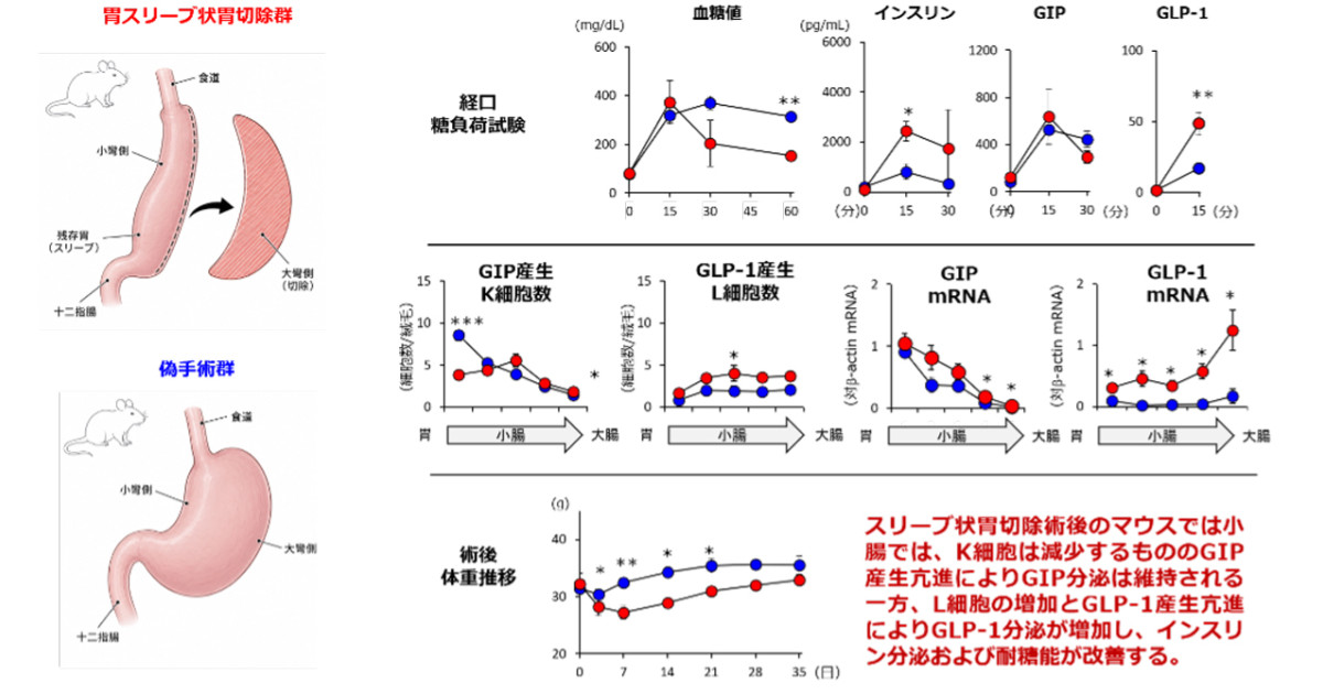 胃の手術が腸ホルモンをどう変える? 3D解析で新発見