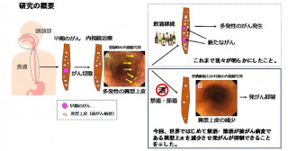 禁酒・節酒が食道粘膜の前がん状態を改善し、食道および頭頸部の発がんを予防することを世界ではじめて明らかにした―アルコール発がん予防の新たな指標―