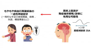 頭皮脳波の超低域徐波が診断に有用―もやもや病術後の一過性神経